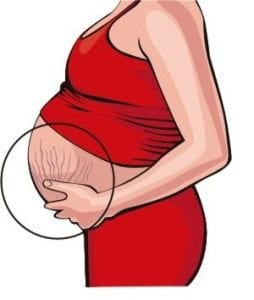 Stretch Marks During Pregnancy