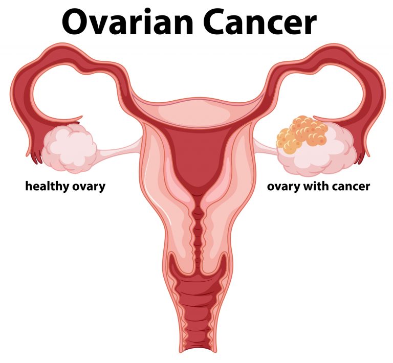  breast-cancer-facts-what-is-breast-cancer